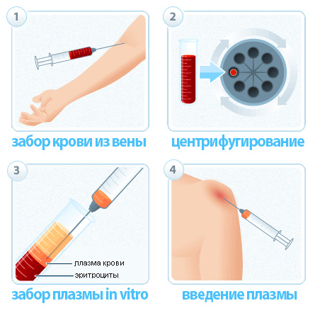 плазмолифтинг